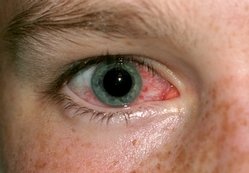 Conjunctivitis